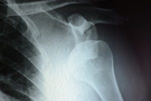 X-Ray of dislocated shoulder