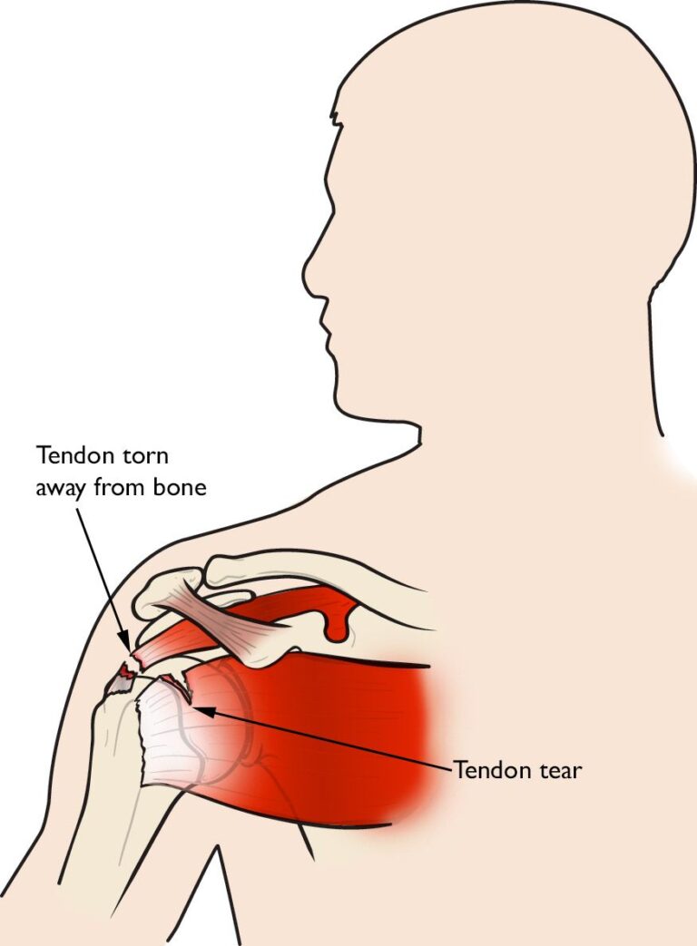 shoulder injury Midwest Bone and Joint Center