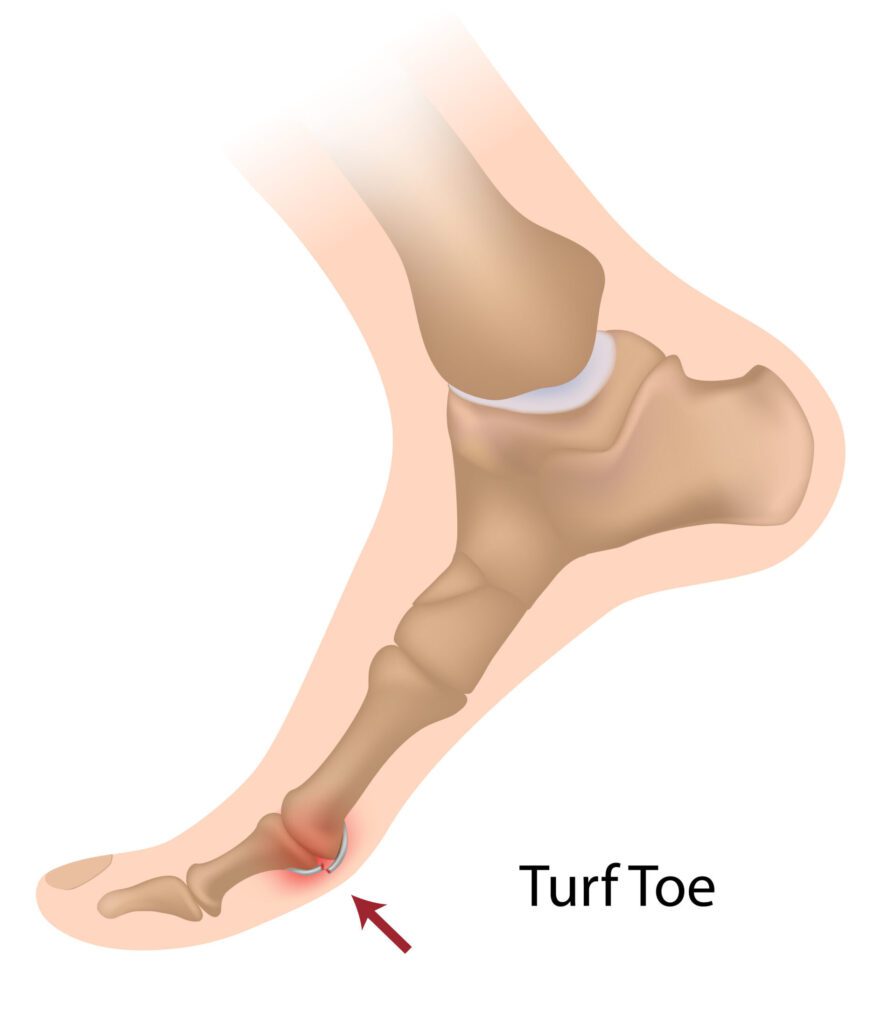 turf toe diagram, showing turf toe inflammation