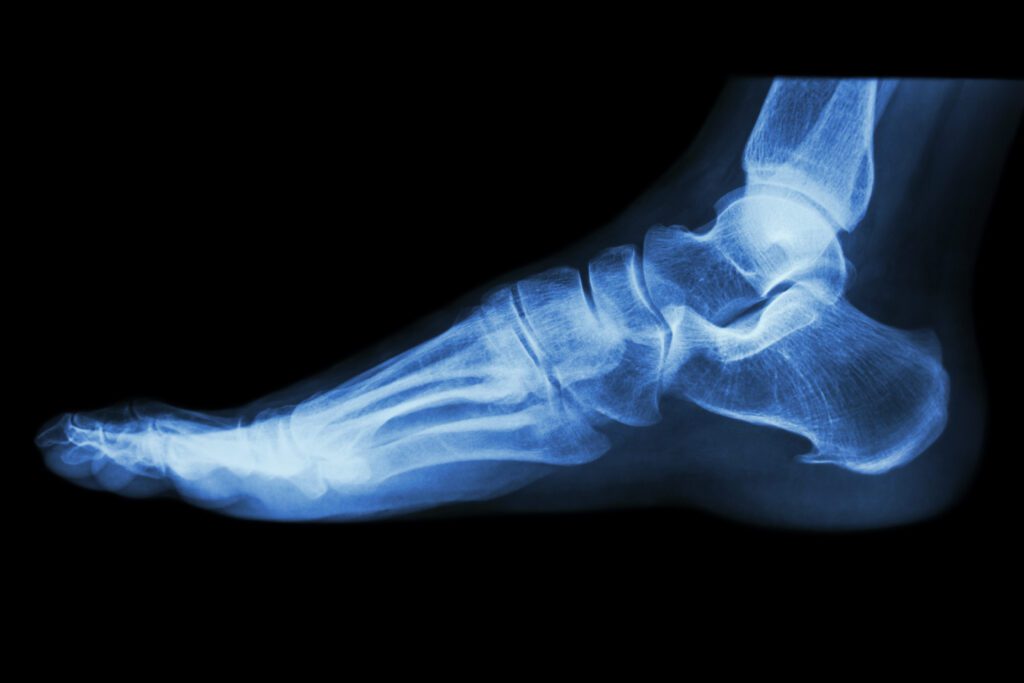 x ray of foot